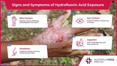 soap2day.hf|hydrofluoric acid exposure.